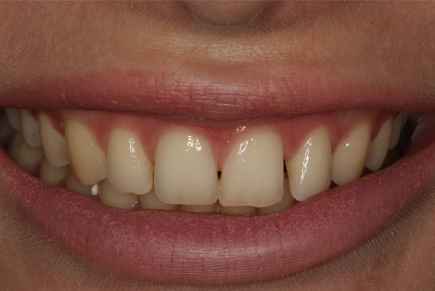 Before