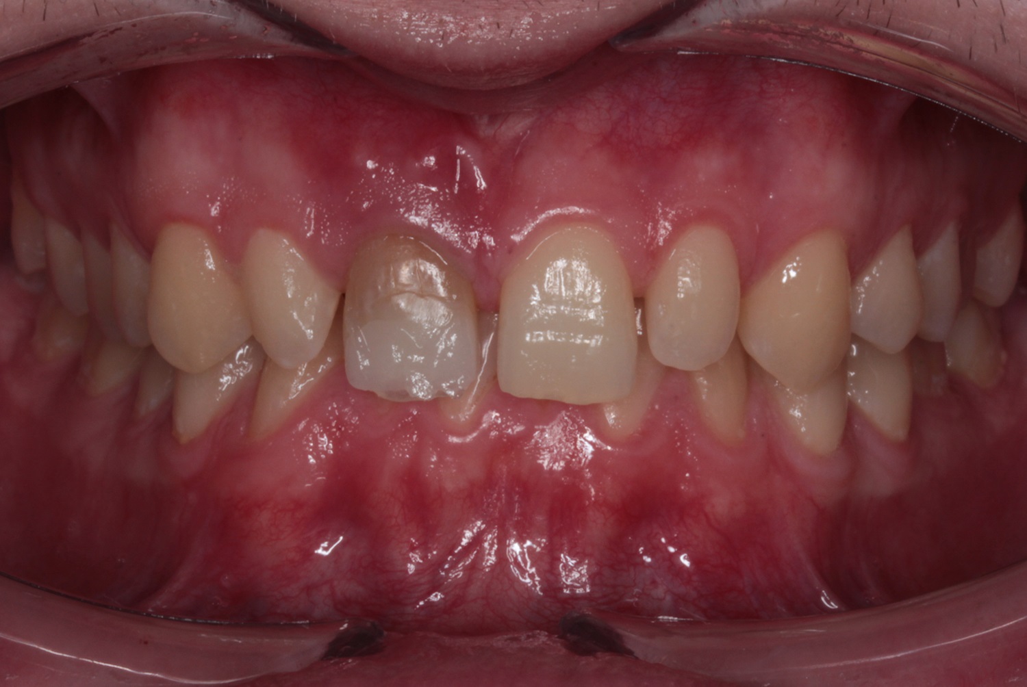 Before